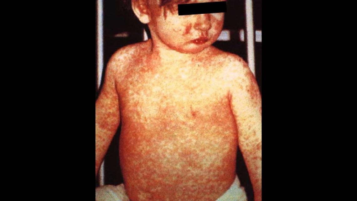 Measles rash can appear 3 to 5 days after the first symptoms, which can include coughing and red, watery eyes.