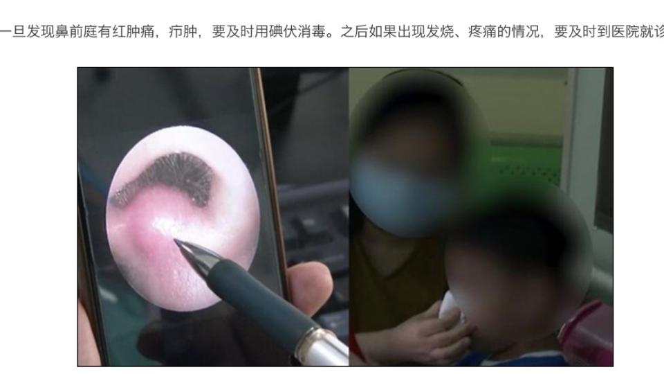 大陸廣東深圳的男童因鼻前庭癤腫導致顱內感染。（圖／翻攝自《快科技》）