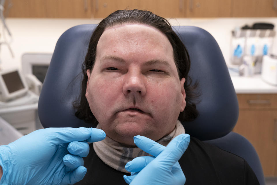 Joe DiMeo whistles softly, Monday, Jan. 25, 2021 at NYU Langone Health in New York, six months after an extremely rare double hand and face transplant. During the medical checkup, he practiced raising his eyebrows, opening and closing his eyes, puckering his mouth, giving a thumbs up and whistling. (AP Photo/Mark Lennihan)