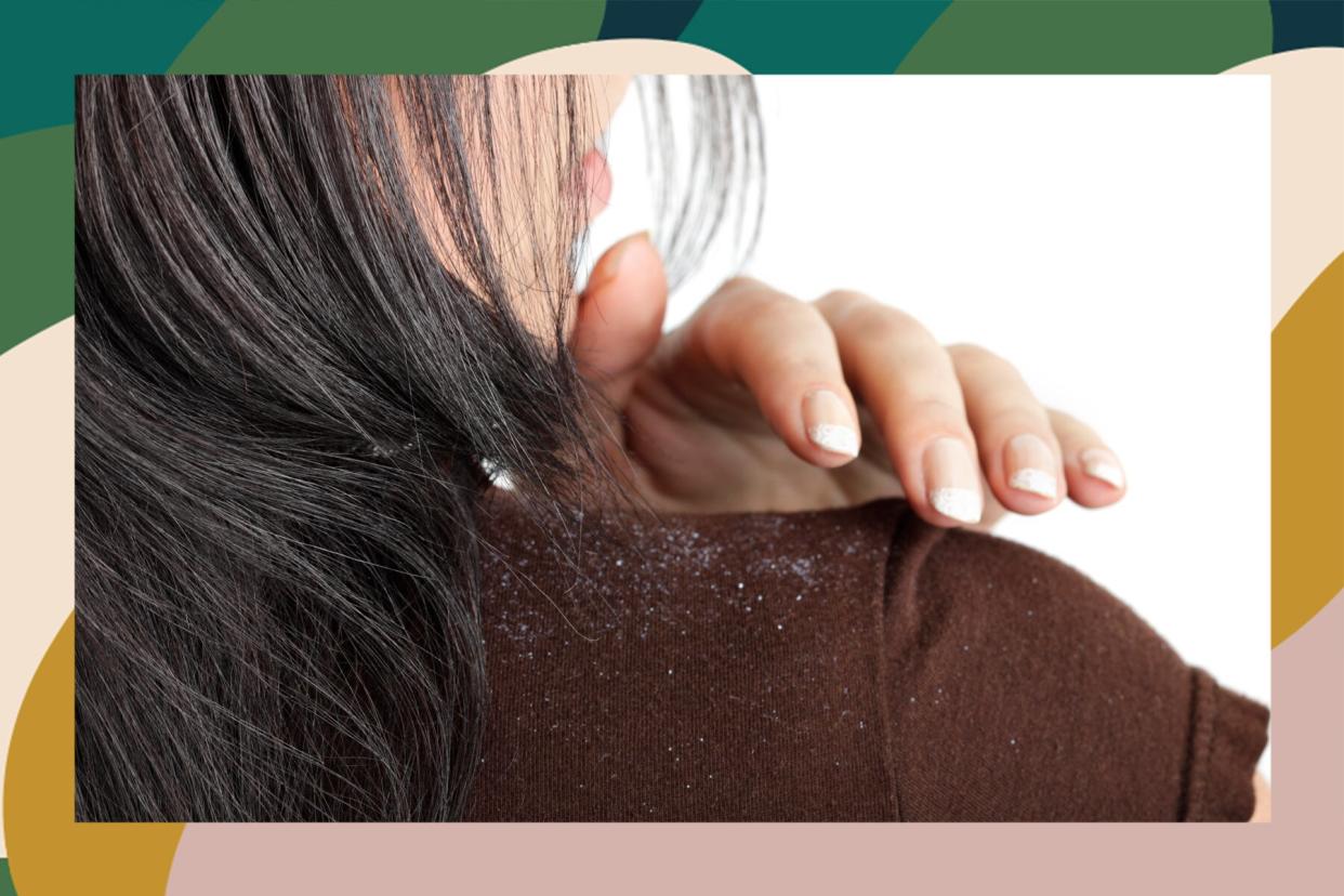 how to treat dandruff tips