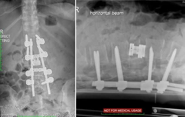 Her spine was shattered but she didn't receive the best care in Peru. Photo: Supplied