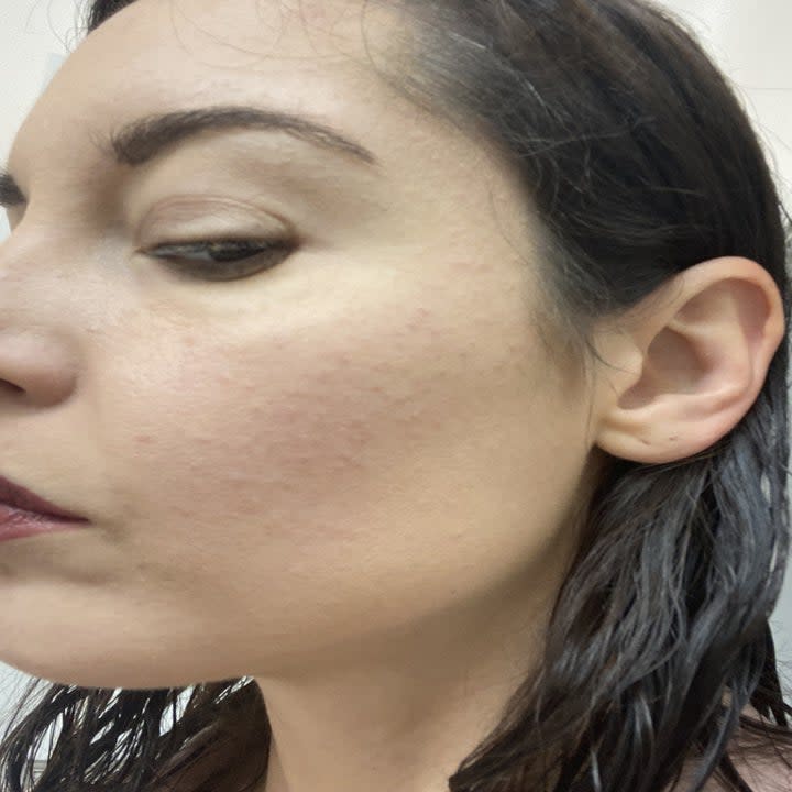Closeup of bumps on Krista Torres' face.