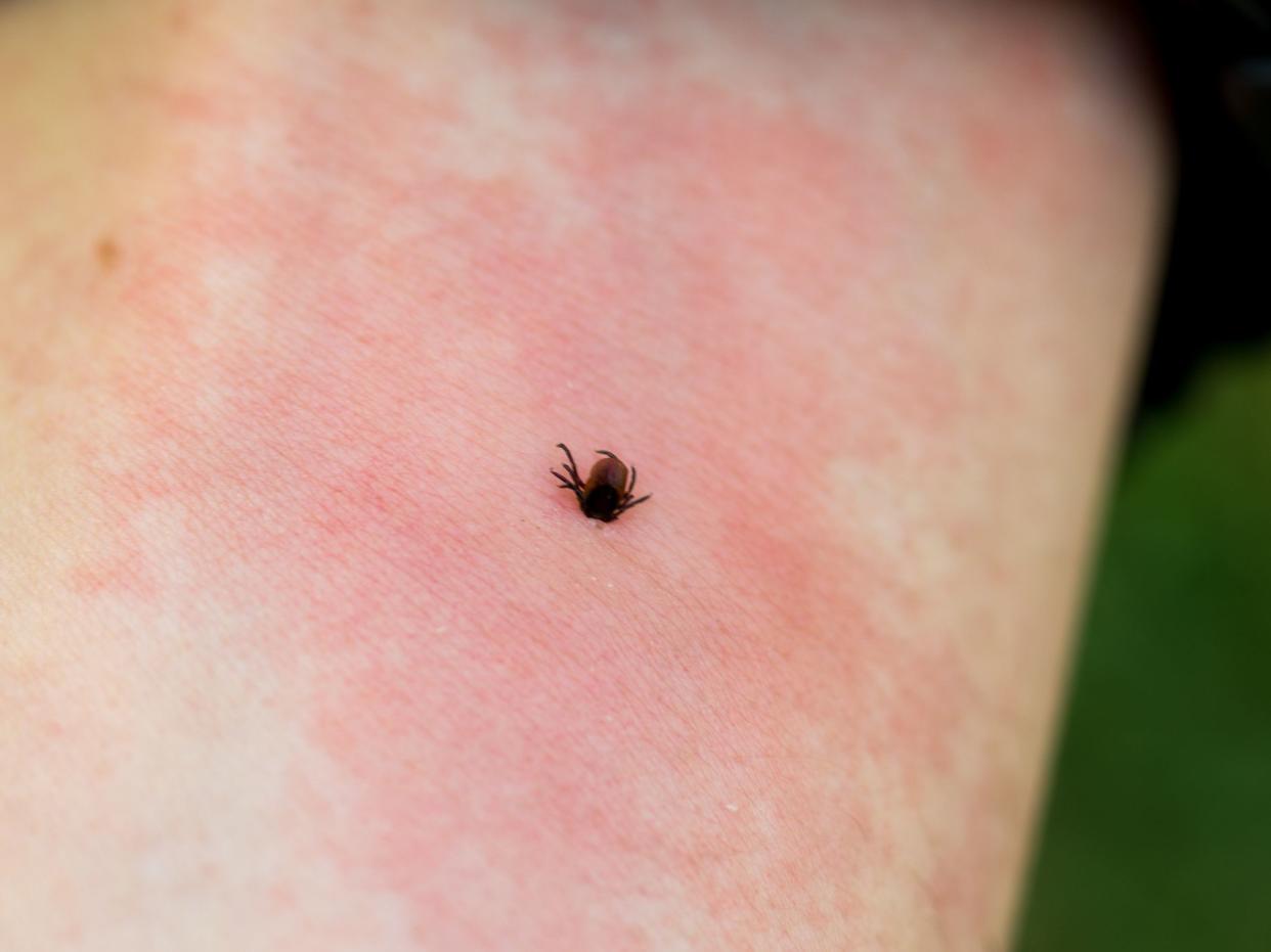 Irritation from the bite. Redness on the skin from a tick bite. A dangerous tick bite. Close-up.