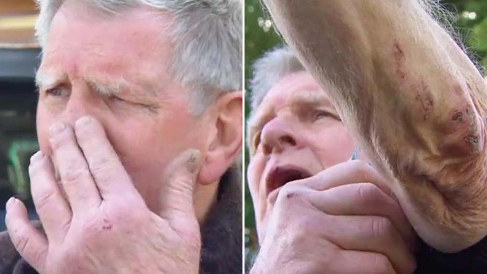 Ray Meyer shows some of his injuries after he was allegedly coward-punched by a teenager. Source: 7 News