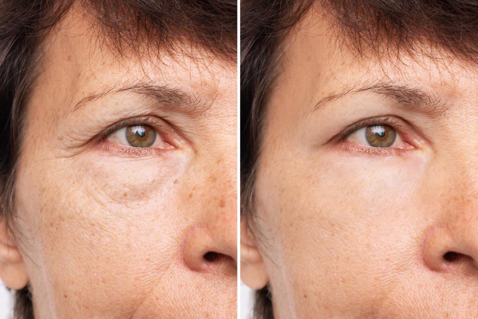 Under-Eye-Wrinkles-Before-After-Stock-Photo