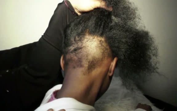 Yamina Zahir shows the large patch of hair missing from the back of her daughter's head that she claims was cut off by school bullies. [Photo: ABC6 Philadelphia]