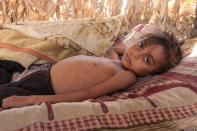 Yemeni boy fights malnutrition as hunger stalks nation's children