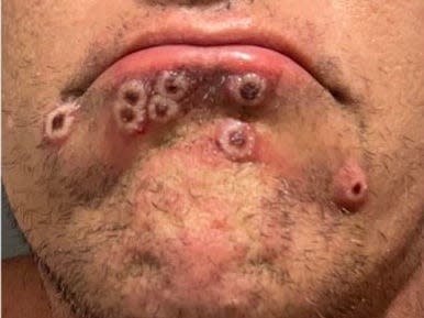 Lesions seen on Steele's face on July 18.