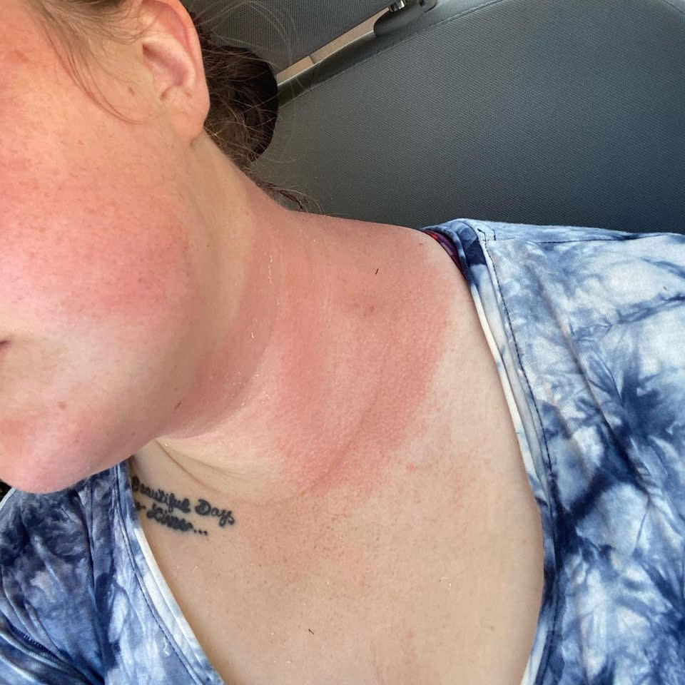 Lacey Brown shows the damage after private security guards, hired by anti-abortion activists, allegedly sprayed her with a chemical irritant during a protest outside of a Planned Parenthood in Walnut Creek, Calif., on Oct. 13, 2020.d (Courtesy Lacey Brown)