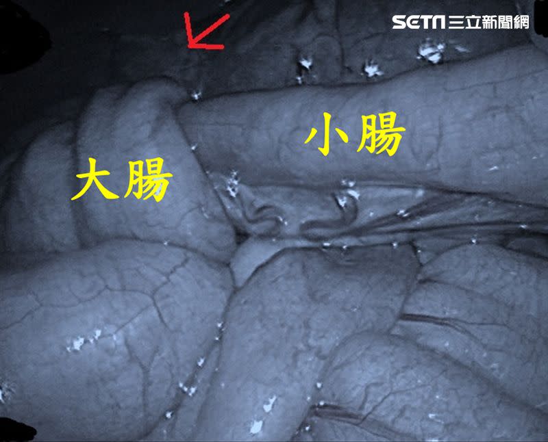 「腸阻塞」很可能是大腸癌的徵兆