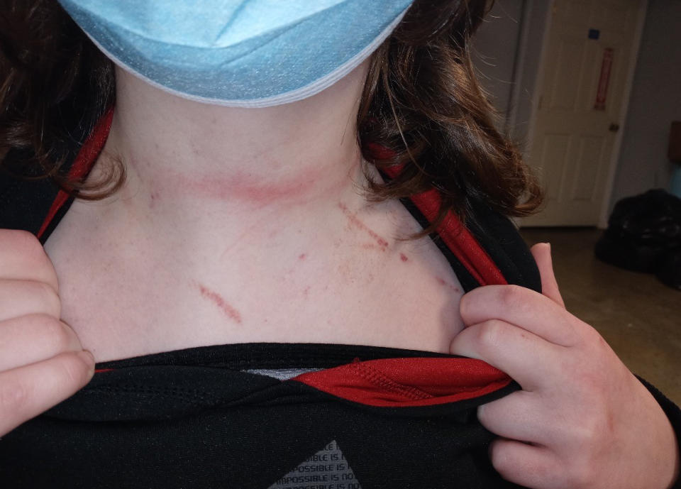 Anthony Janeway shows bruises on his neck. (Courtesy Autumn Janeway)