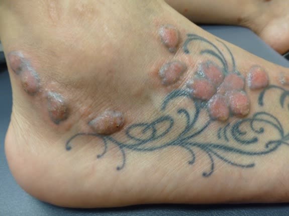 Are tattoo allergies permanent? Anyone have experience with tattoo