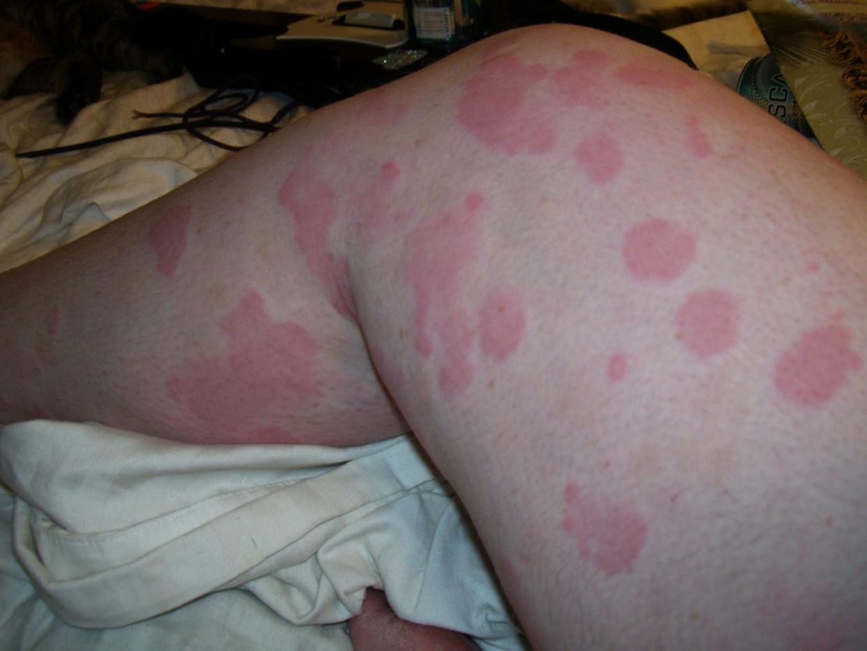 hives urticaria identification picture