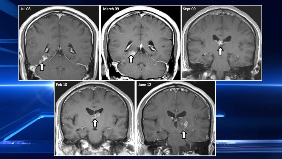 Tapeworm Lives In Man's Brain For Four Years