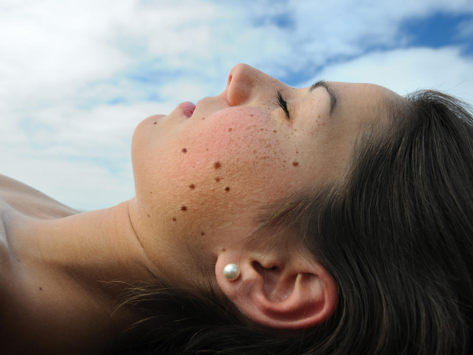 There are a number of things that will up your skin cancer risk [Photo: Getty]