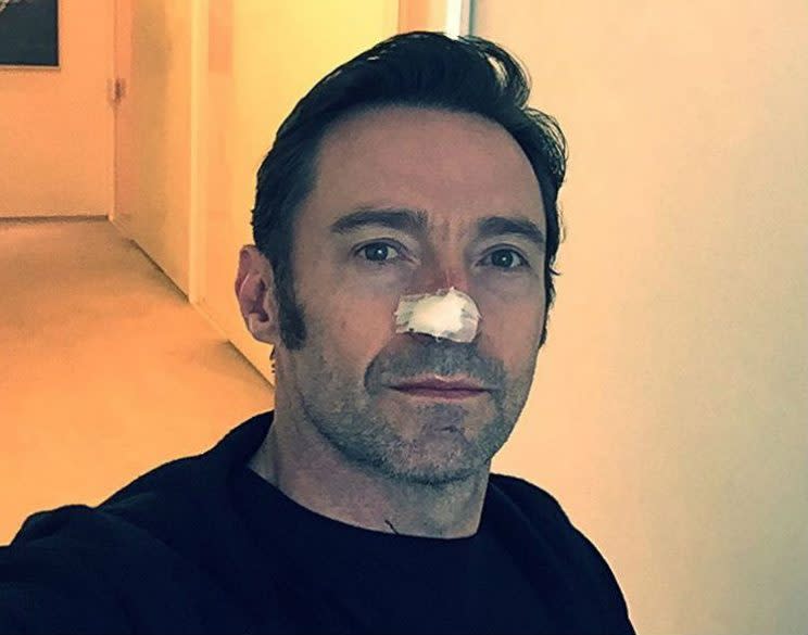 Jackman… reveals another skin cancer scare – Credit: Instagram