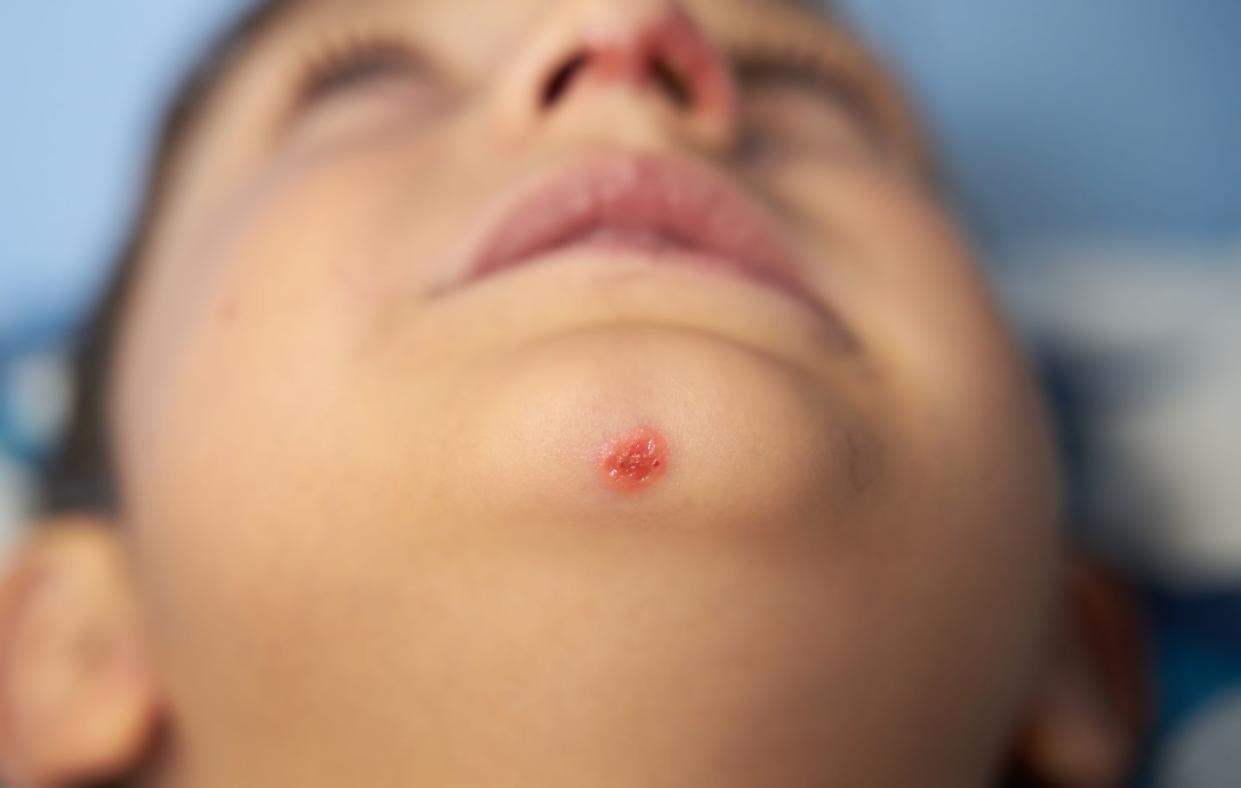 impetigo is a common skin infection that causes blisters anywhere on the body