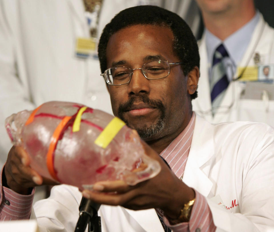 FILE - In this Sept. 16, 2004, file photo, Dr. Ben Carson, then-director of pediatric neurosurgery at Johns Hopkins Children's Center, holds a model of the heads of conjoined twins Tabea and Lea Block of Lemgo, Germany, during a news conference in Baltimore. Carson’s story of growing up in a single-parent household and climbing out of poverty to become a world-renowned surgeon was once ubiquitous in Baltimore, where Carson made his name. But his role as Housing and Urban Development Secretary in the Trump Administration has added a complicated epilogue, leaving many who admired him feeling betrayed, unable to separate him from the politics of a president widely rejected by African Americans here. (AP Photo/Chris Gardner, File)