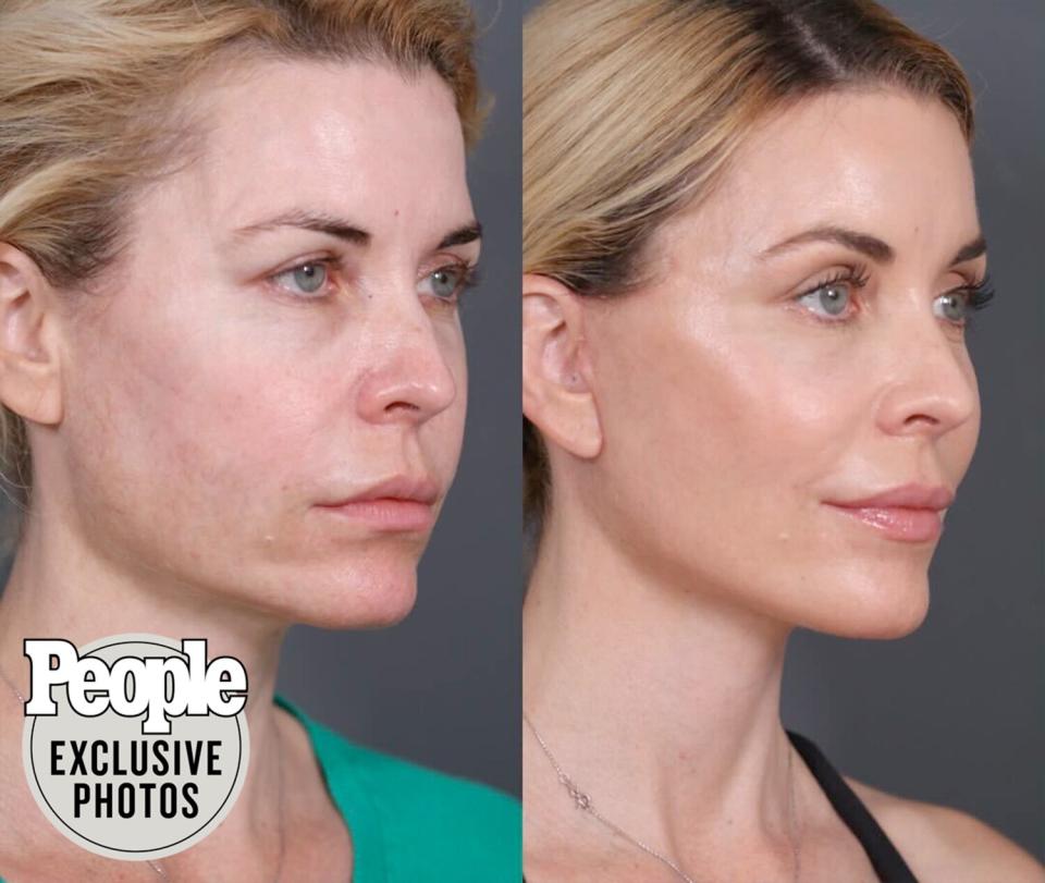 McKenzie Westmore Shares Transformation Photos After Her Face Lift with Dr. Nassif
