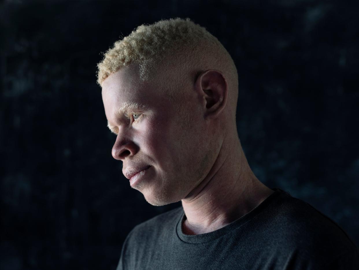 Charles Marekera, 16, was forced to leave DRC with his parents to escape persecution for being an albino: Pictures by Paddy Dowling