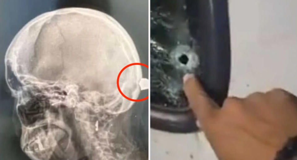 (Left) The X-ray scan showing the bullet lodged in Damariz’s scalp. (Right) The bullet hole in the car’s window.