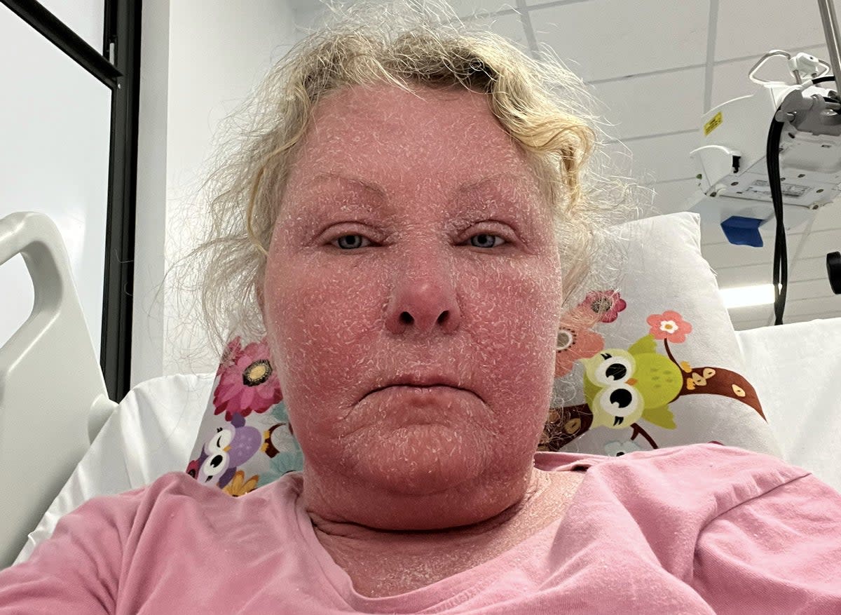 Sharon Shute said it felt like her face was on fire as she went through severe topical steroid withdrawal (Sharon Shute / SWNS)