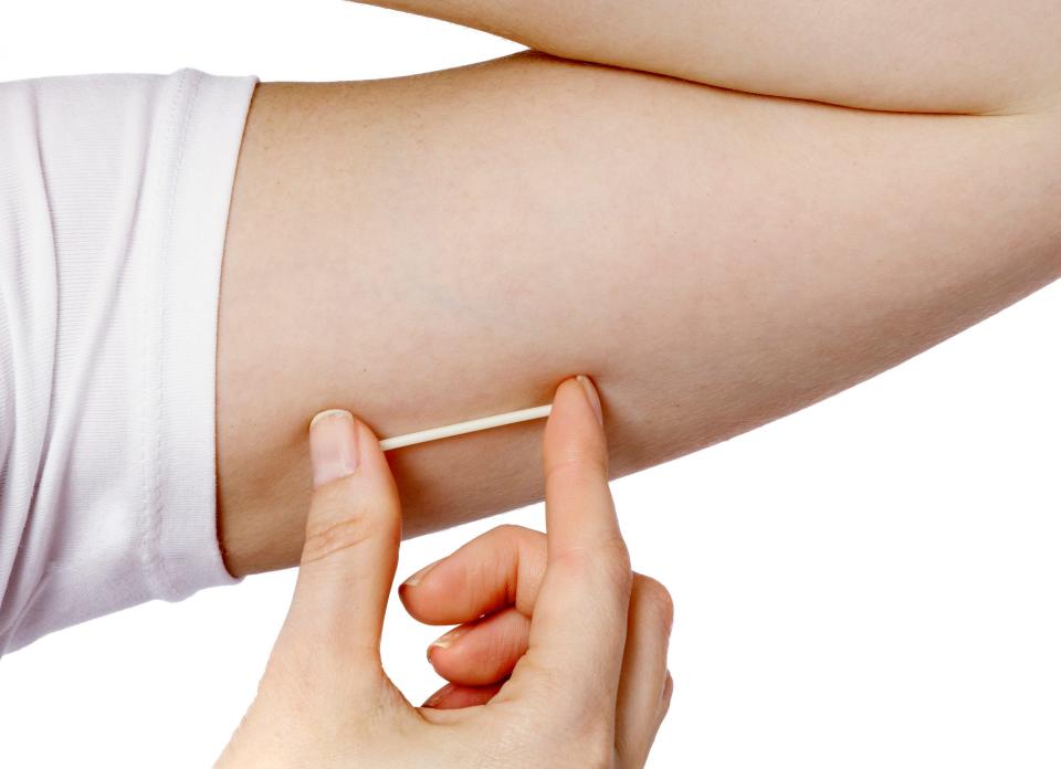 A woman holds a Nexplanon birth control hormonal implant. Implants are a type of long-acting, reversible contraception in the group considered "most effective," with less than one pregnancy per 100 women in one year.