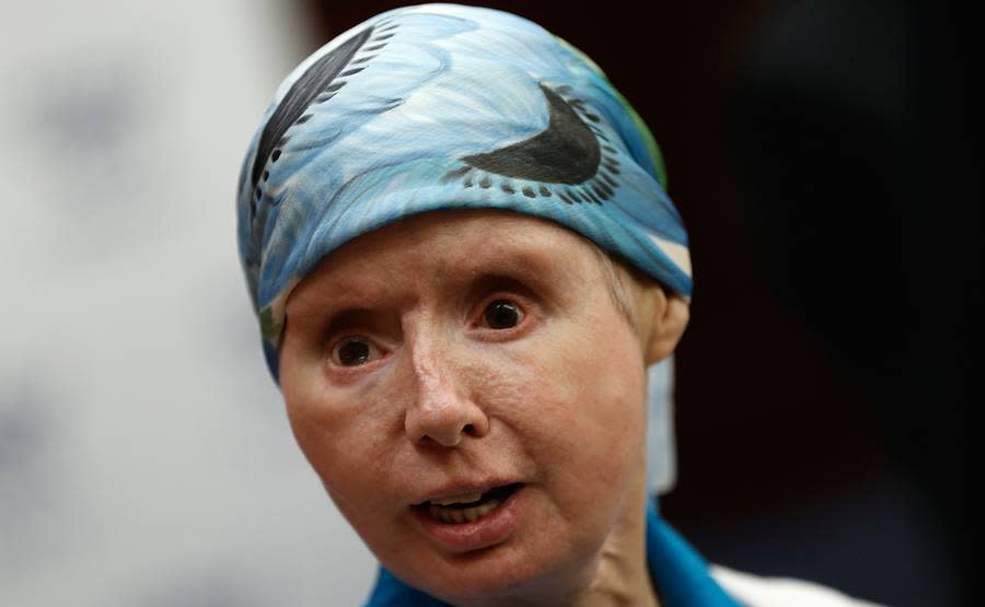 Charla Nash's Body Rejected Her Face Transplant — But the Chimp Attack Suvivor Will Be OK