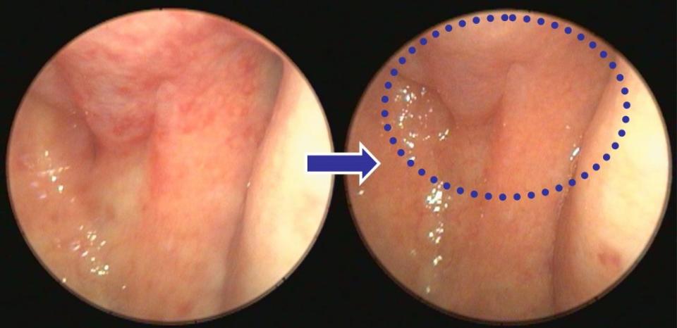 左圖為患者初診時，鼻咽黏膜紅腫且有潰瘍紅點；右圖，治療後黏膜潰瘍痊癒（圈圈處），不再出現「爆炸頭症候群」。<br />（陳建志醫師提供）