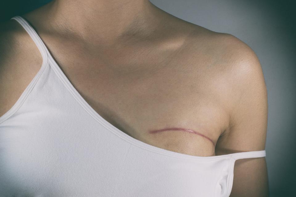 breast cancer surgery scar