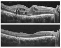 糖尿病黃斑部水腫治療前(上)、後之光學相干斷層掃描（OCT）比較。中間水腫明顯減少（下）。<br /> （基隆長庚醫院提供）