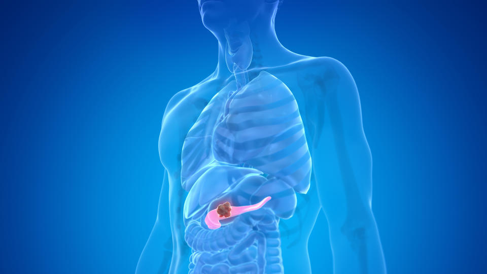 Pancreas cancer, illustration.