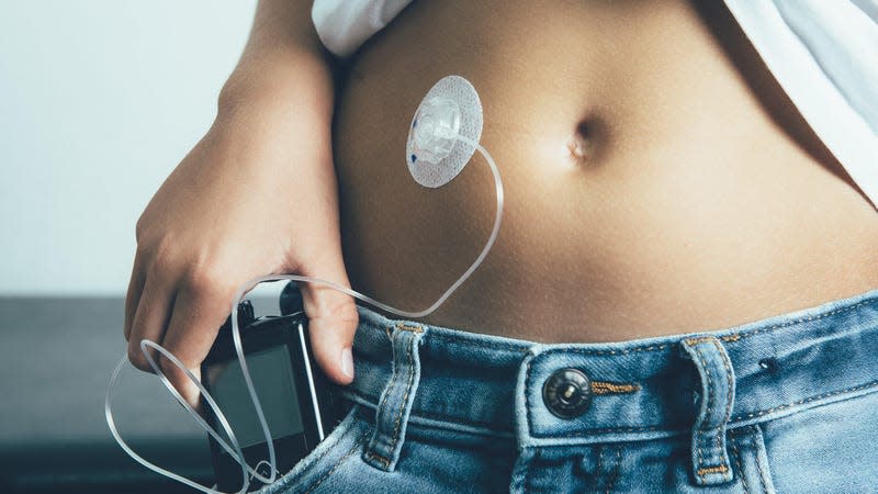 The artificial pancreas device combines an under-the-skin sensor to measure blood glucose with existing insulin pump technology, seen above, to more seamlessly deliver insulin to users when needed. - Image: Click and Photo (Shutterstock)