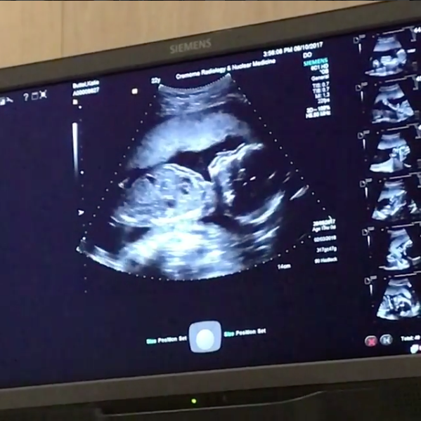 Katie shared this ultrasound photo of their baby boy. Photo: Instagram