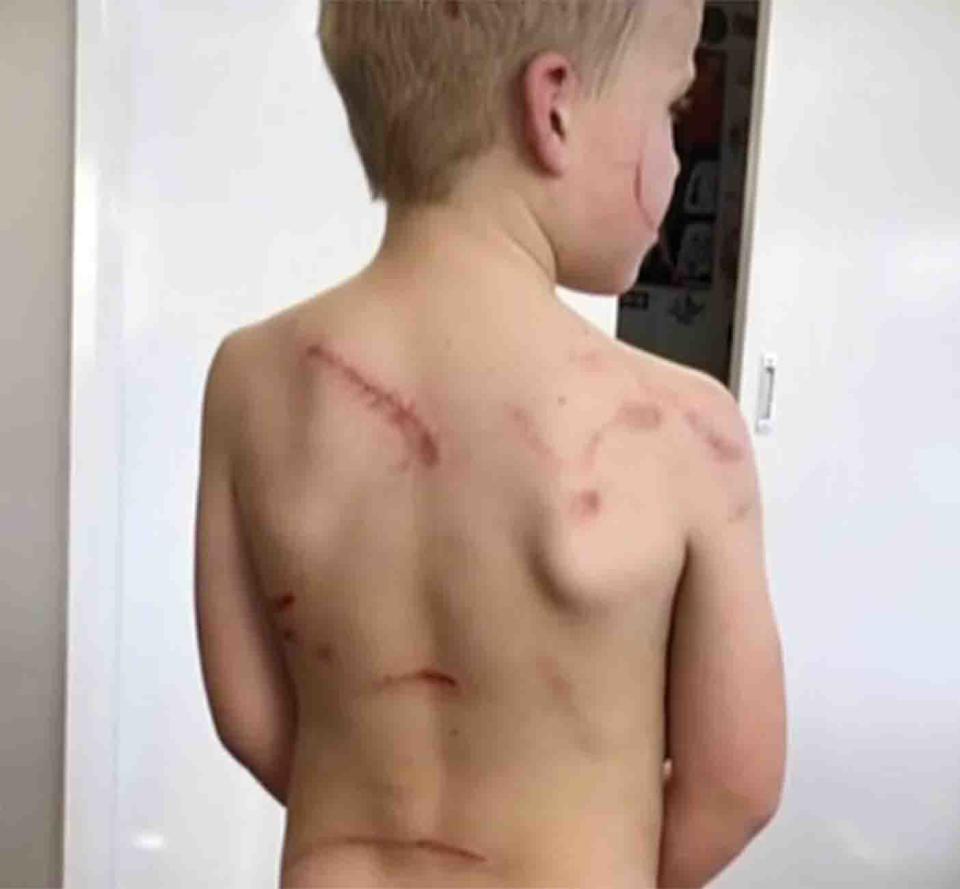 A kangaroo scratched Lewis Dyer at his Valla Beach backyard. A photo of deep scratches on the boy's back.