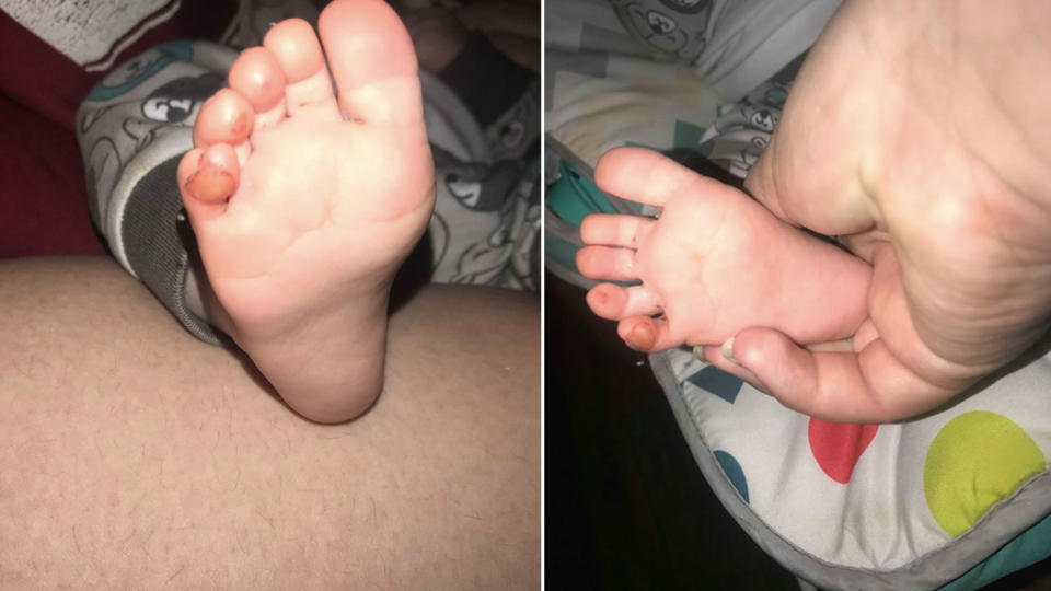 Parker was left with a blister on his baby toe. Photo: Supplied