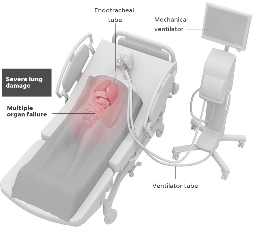 How a mechanical ventilator works.