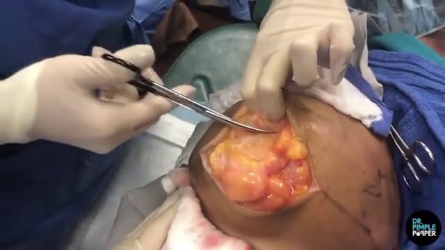 Dr. Pimple Popper -- Shocking Huge Cyst Looks Like 'Breast' Growing Out Of  A Back