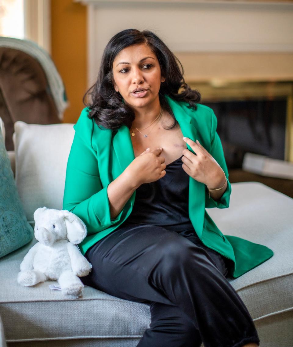 Sveta Prakash Desai, 40, shows the scar from the port used to treat her breast cancer that is currently in remission at her home in Troy, Mich. on Nov. 16, 2023. Desai wanted to have a child after completing cancer treatment, but her body didn't cooperate. Sveta is now expecting a baby this March to be born via surrogate.