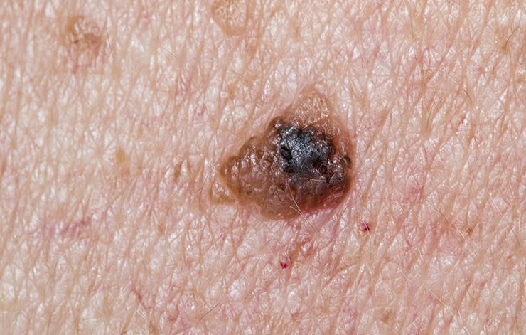 5 Signs Of Skin Cancer That Are Easy To Overlook