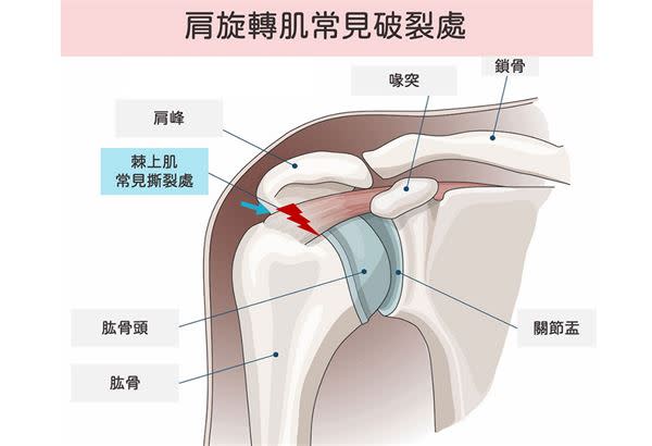 （圖片提供／侯鐘堡醫師By復健醫學會）