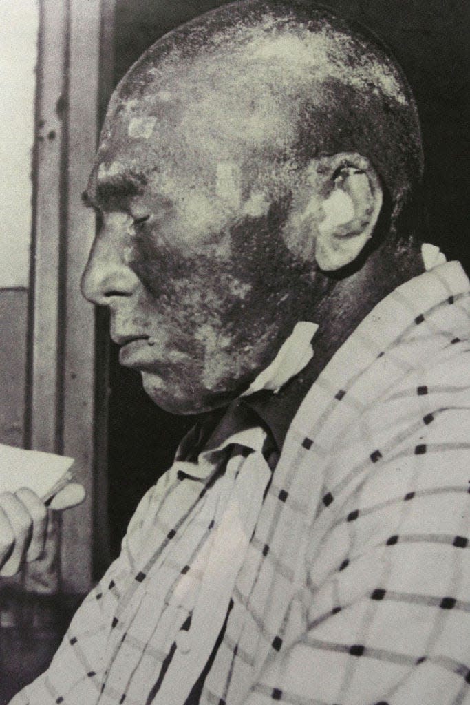 Portrait of crew member on the Lucky Dragon ship showing his skin burns and discoloration from nuclear fallour.