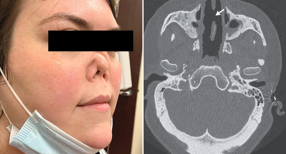 A CT scan shows a collapsed nasal cavity. Also pictured is a 34-year-old woman with a shrunken nose.