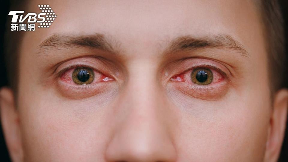 紅眼為新冠肺炎常見的眼部症狀。（示意圖／shutterstock達志影像）