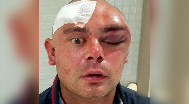 Kenny McSween was left with gruesome injuries from the attack. Photo: Supplied