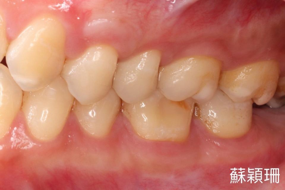 術後牙齦恢復正常的高度與厚度。慈濟醫院提供