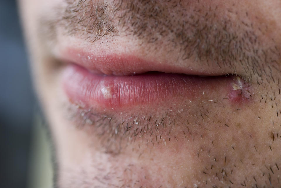 Cold sores can be painful, but they usually heal within one to two weeks. (Image via Getty Images)