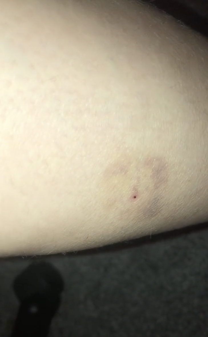 One TikTok user had an identical wound after a night out where she can't recall anything. Source: TikTok/isabelladortax
