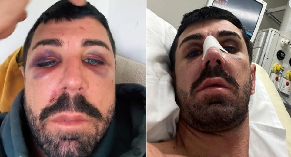 Aaron pictured showing his injuries after attacked in Oxford St, Sydney.