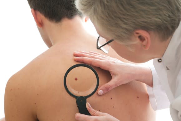 Doctor looking at a spot on a patient's back with a magnifying glass